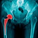 hip replacement joint